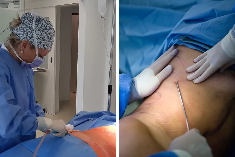 Intervento di liposuzione in sala operatoria